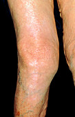 Elderly woman's knee affected by osteoarthritis