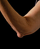 Rheumatoid arthritis forming nodule in the elbow