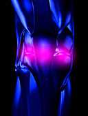 Computer artwork of rheumatoid arthritis in knee