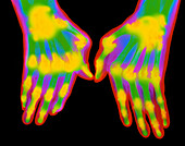 Coloured X-ray of hands with rheumatoid arthritis