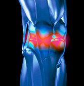 Computer artwork of knee with rheumatoid arthritis
