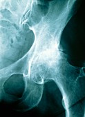 X-ray of osteoarthritis of the hip of a woman