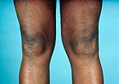 View of knees affected by osteoarthritis