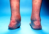 Valgus heels caused by rheumatoid arthritis