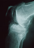 Knee osteoarthritis