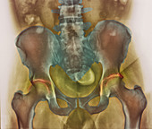 Osteoarthritic pelvis,X-ray