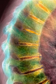 Arthritis of the spine,X-ray