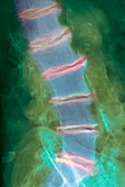 Arthritis of the back,X-ray