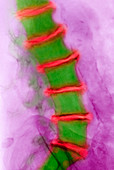 Arthritis of the back,X-ray