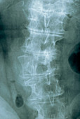 Osteoarthritis of the spine,X-ray