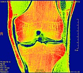 Joint disease,CT scan
