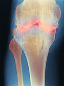 Fused knee joint,X-ray