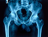 Osteoarthritis,X-ray