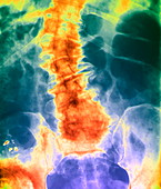 Diseased spine