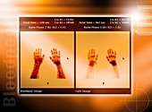 Arthritic hands,scintigram