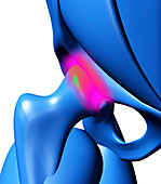 Arthritic hip,computer artwork