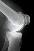 Arthritic knee,X-ray