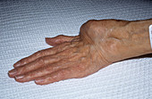 Arthritic wrist