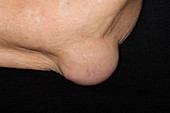 Rheumatoid arthritis nodule