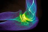 Arthritic elbow,X-ray