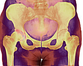 Osteoarthritis of the hip,X-ray