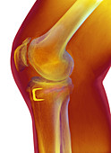 Osteoarthritis of the knee,X-ray