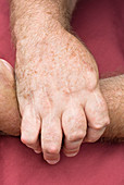 Rheumatoid arthritis