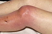 Septic arthritis of the knee