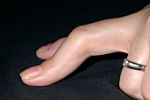 Deformed finger in rheumatoid arthritis
