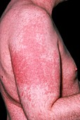 Scabies rash on arm of AIDS patient