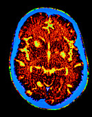 F/col CT scan of brain with toxoplasmosis in AIDS