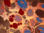 Coloured TEM of Kaposi's sarcoma a skin cancer