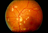 Ophthalmoscopy of CMV retinitis in AIDS patient