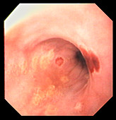Oesophageal herpes in AIDS