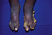 Kaposi's sarcoma of the feet