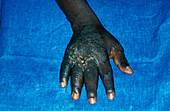 Kaposi's sarcoma of the hand
