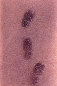 Kaposi's sarcoma skin plaques