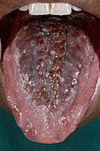 Kaposi's sarcoma of the tongue