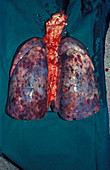 Kaposi's sarcoma of the lungs