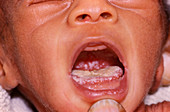 Oral thrush in AIDS baby
