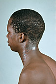 AIDS man with dermatitis