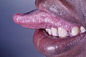 AIDS woman with tongue plaques
