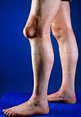 Pre-patellar bursa: swelling on knee