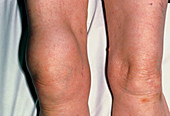Supra-patellar bursitis: swollen right knee
