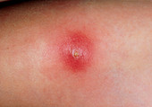 Close-up of a boil on an infant's forearm