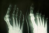 Bunion on big toe: X-ray pre- & post-surgery
