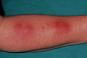 Boil's on forearm due to Staphylococcus infection