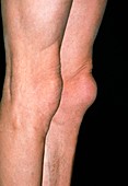 Swollen,housemaids knee: pre-patellar bursitis