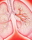 Lungs with bronchitis