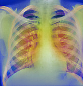 Chronic bronchitis,X-ray